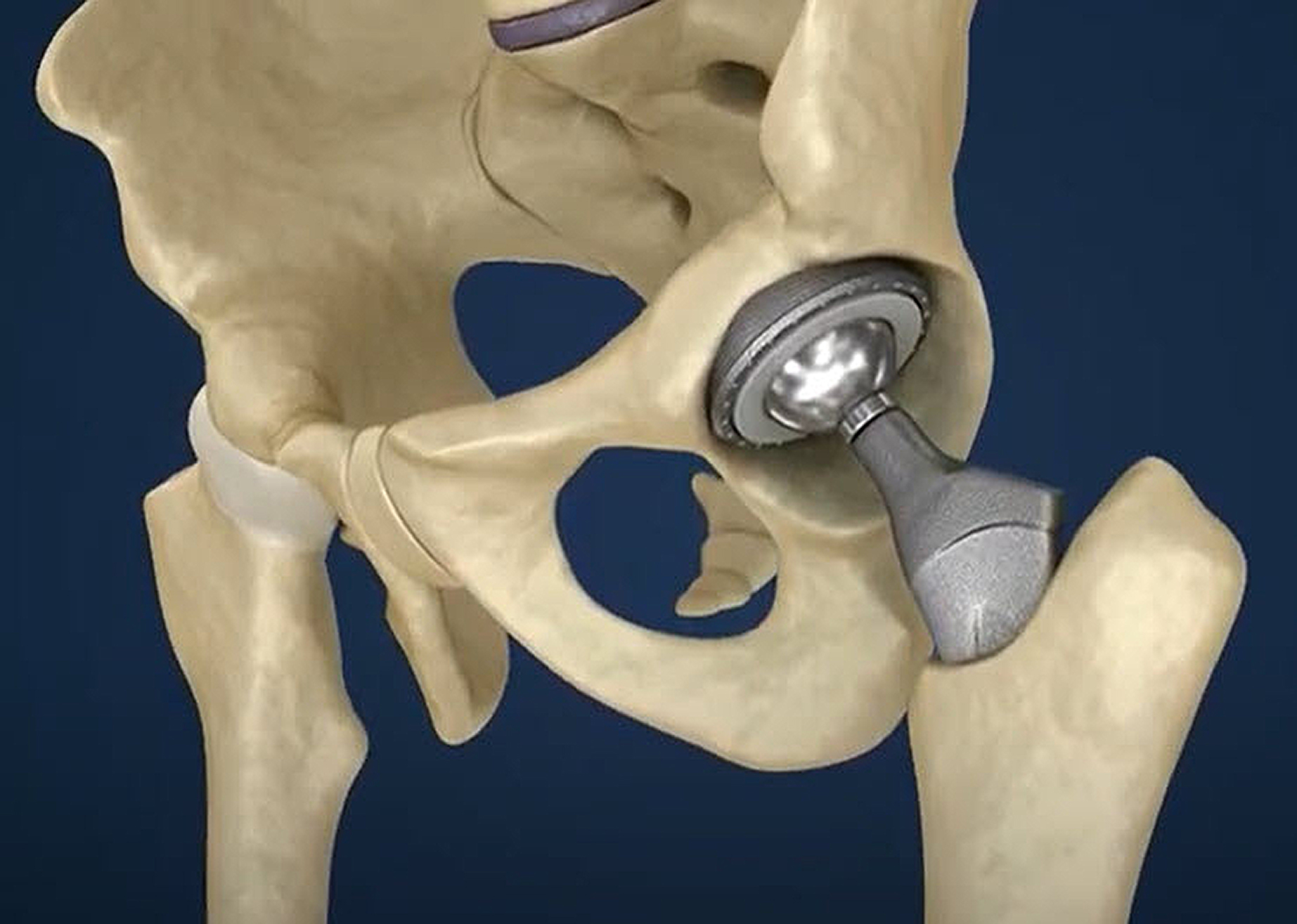 ANCA is on the ‘ball’ with hip implants
