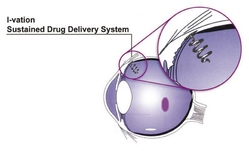 Manufacturing minimally invasive medical devices